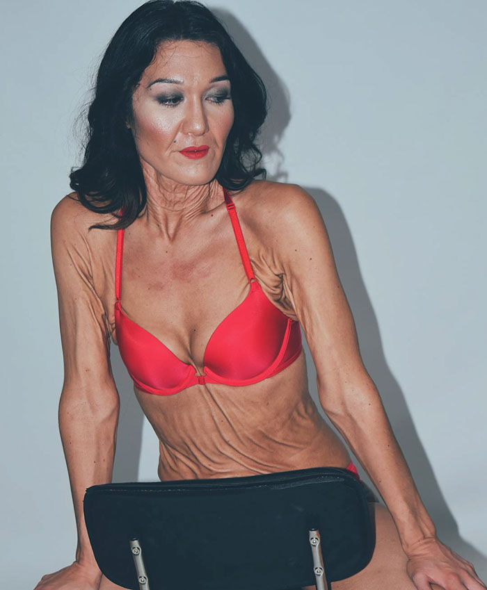 26-летняя модель которая выглядит на 50, Сара Гюртс, Синдром Элерса-Данлоса