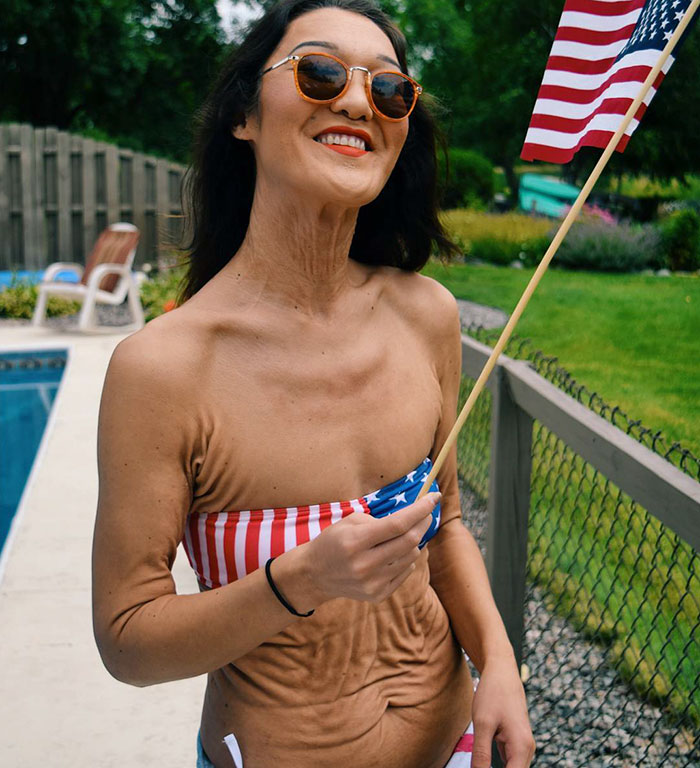 26-летняя модель которая выглядит на 50, Сара Гюртс, Синдром Элерса-Данлоса