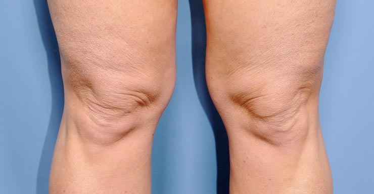 что мы не знали о бёдрах, проблемные бёдра