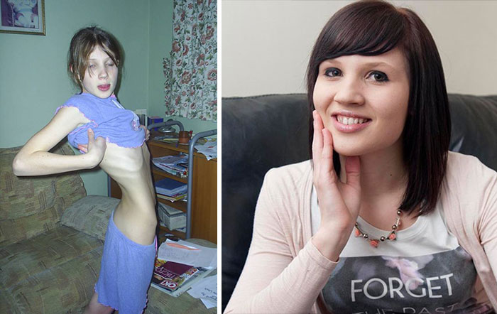 до и после анорексии, люди которые смогли победить анорексию