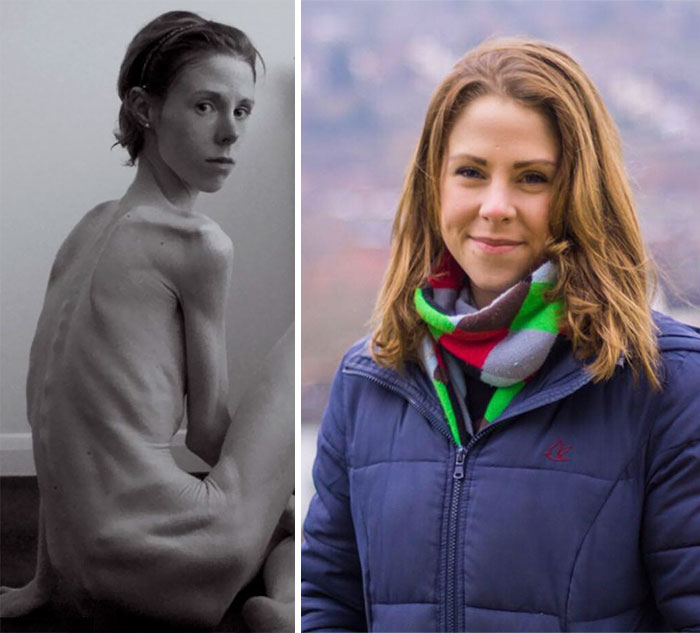 Люди победившие анорексию фото до и после