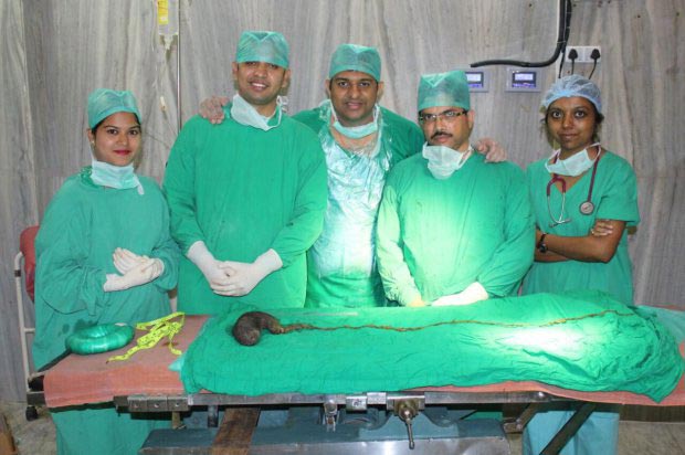 Врачи вытащили огромный 750-граммовый комок волос из живота женщины