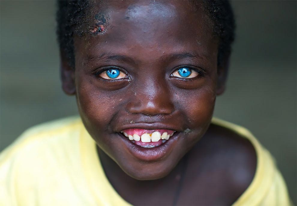 Невероятно красивые глаза африканского мальчика подаренные ему болезнью