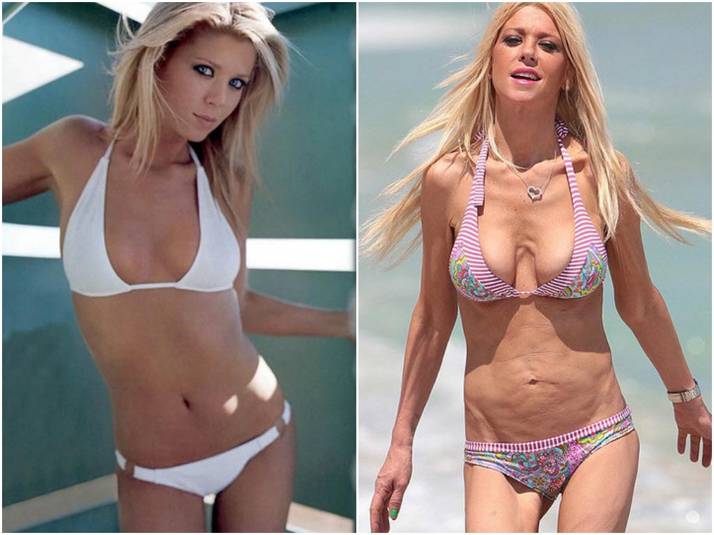 неудачные пластические операции звёзд, звёзды с неудачной пластикой