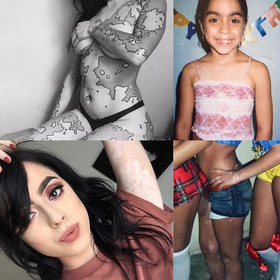 Люди издевались над этой девушкой с витилиго, но она смогла превратить свою болезнь в искусство в серии горячих фотографий издевались над девушкой с витилиго, модель с витилиго, Эшли Сото, Ashley Soto, инстаграм Эшли Сото