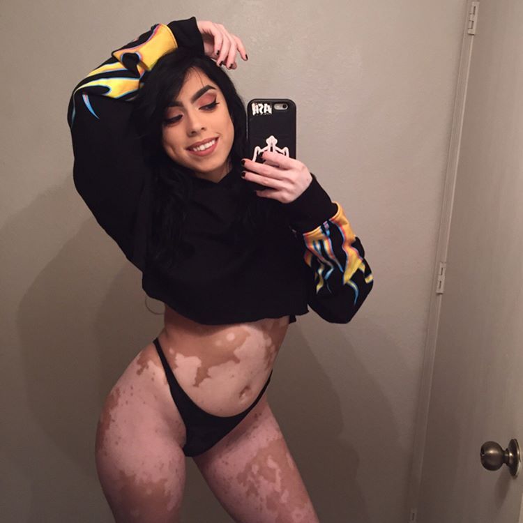 Люди издевались над этой девушкой с витилиго, но она смогла превратить свою болезнь в искусство в серии горячих фотографий издевались над девушкой с витилиго, модель с витилиго, Эшли Сото, Ashley Soto, инстаграм Эшли Сото