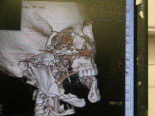 жизнь после самоубийства, пережила попытку самоубийства, жизнь после неудачной попытки самоубийства, лицо после попытки самоубийства