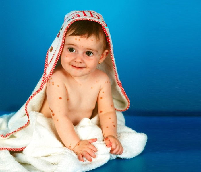 девушка с 500 родинками, Альба Парехо, Alba Parejo