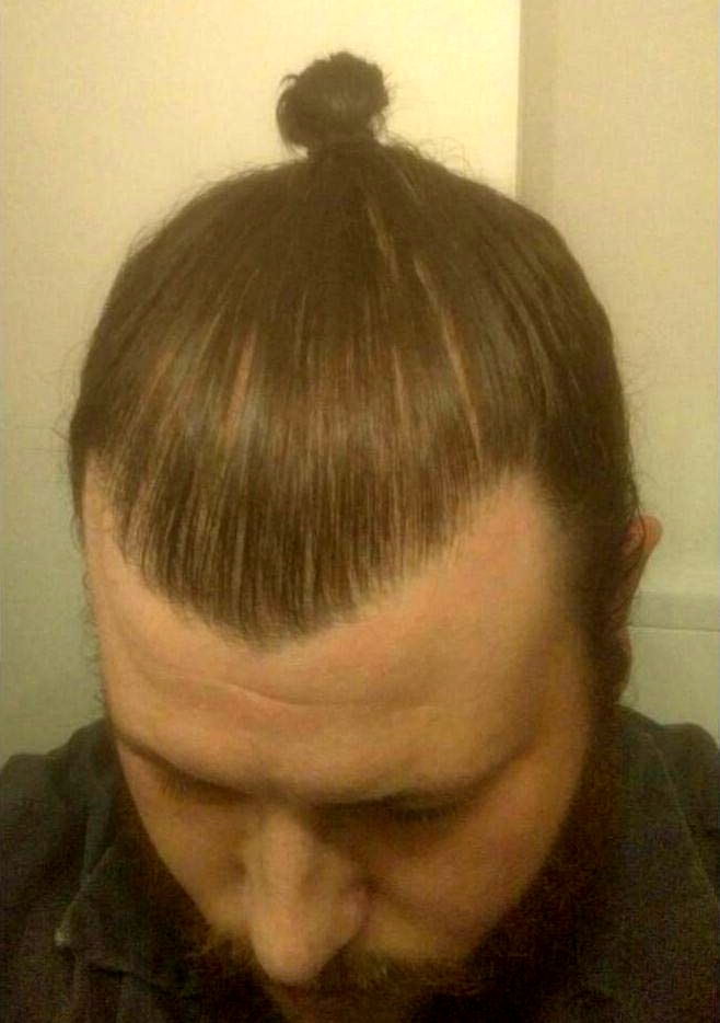 прятать лысину гулька, спрятали облысение гулька