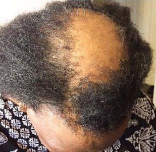 прятать лысину гулька, спрятали облысение гулька