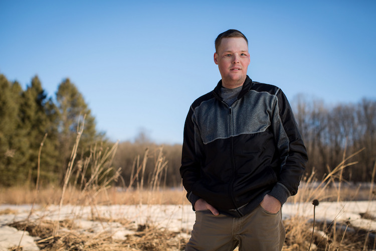 Невероятные результаты пересадки лица, сделанной парню после того, как он выстрелил себе в лицо Энди Санднесс, Andy Sandness, Пересадка лица до и после, результат пересадки лица