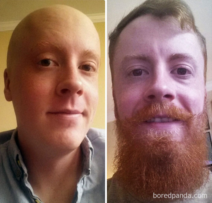 Победили рак сами. Люди до и после химиотерапии. Люди после химиотерапии до и после. Борода после химиотерапии. Раковые больные до и после.
