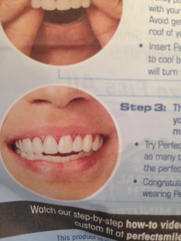 Женщина купила дешёвые готовые виниры, но когда она их надела, у неё началась истерика дешёвые виниры, готовые виниры, женщина купила дешёвые виниры, виниры отзывы