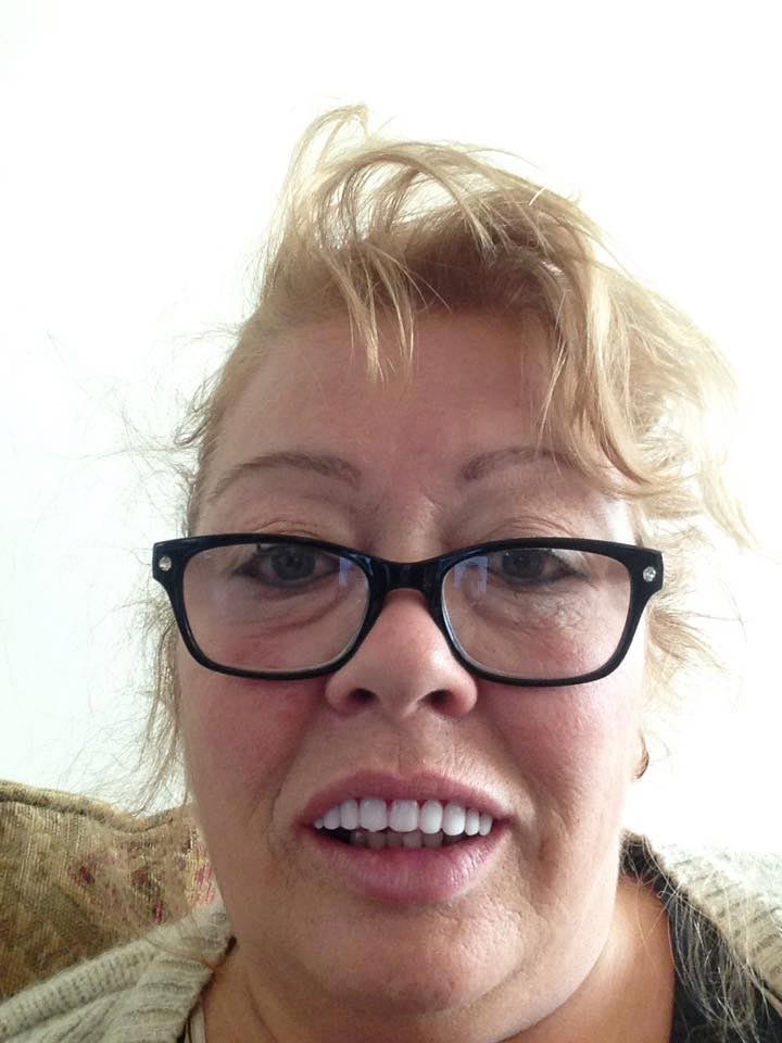 Женщина купила дешёвые готовые виниры, но когда она их надела, у неё началась истерика дешёвые виниры, готовые виниры, женщина купила дешёвые виниры, виниры отзывы