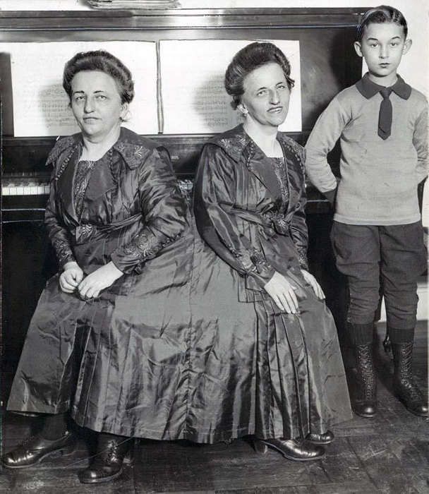 сиамские близнецы, истории о сиамских близнецах 