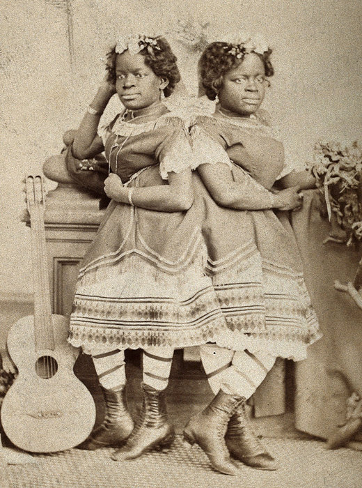 сиамские близнецы, истории о сиамских близнецах 