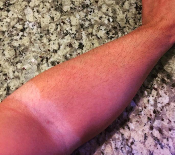 случаи с автозагаром, неудачное использование автозагара