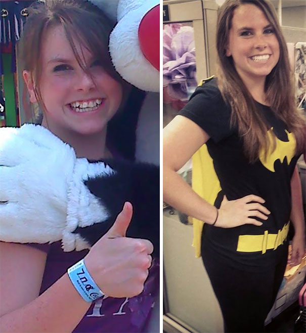 до и после брекетов, люди с брекетами 