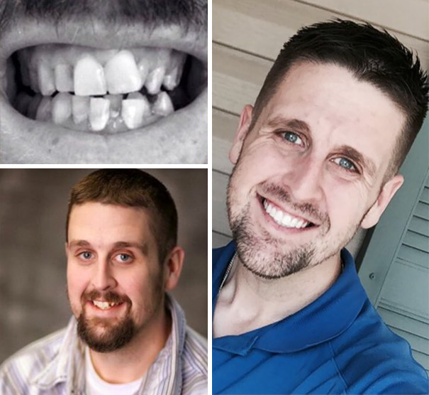Фото зубов до и после брекетов фото