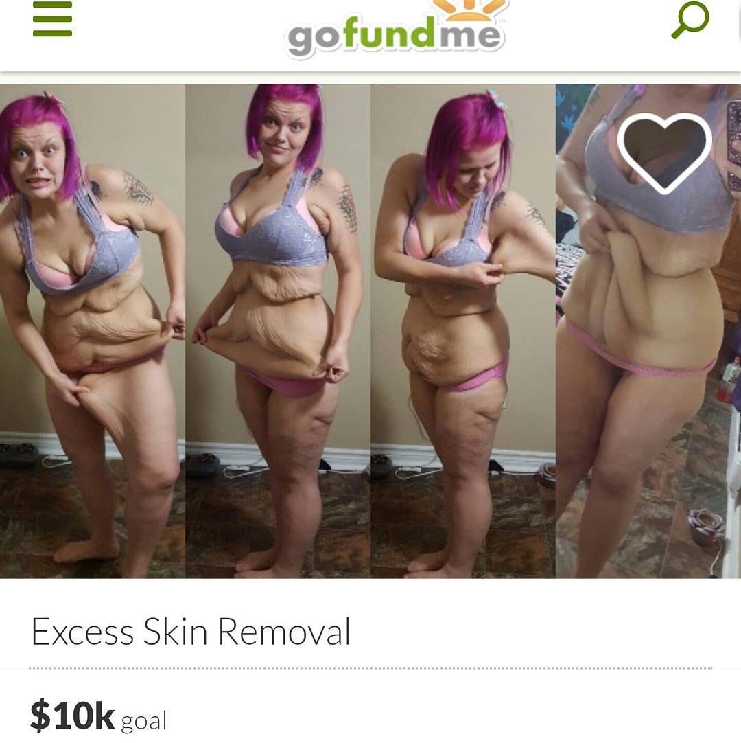 огромное количество лишней кожи, лишняя кожа после похудения, Кайла Батчер, Kayla Butcher)