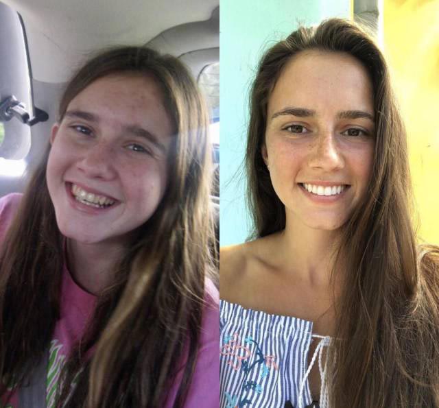 30 несуразных подростков, которые с возрастом превратились в секси-шмекси подростки выросли в красавцев, несуразные подростки в горячих красавцев, подростки изменились с возрастом, люди с возрастом сильно изменились