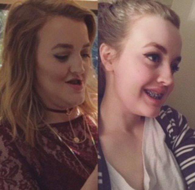 пластика подбородка, пластическая хирургия изменила лицо, пластическая операция изменила лицо, до и после пластической операции