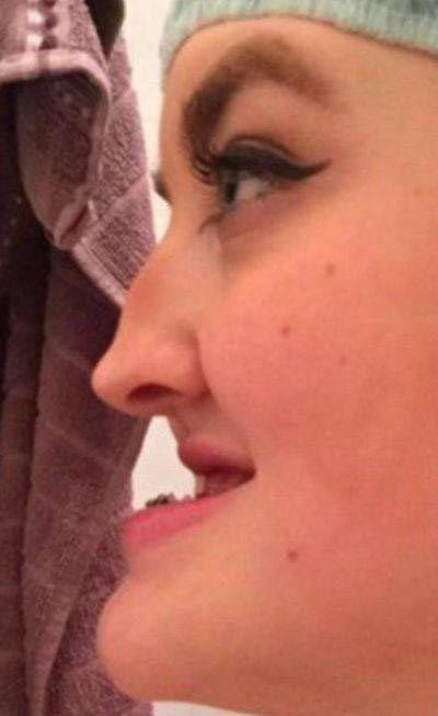 пластика подбородка, пластическая хирургия изменила лицо, пластическая операция изменила лицо, до и после пластической операции