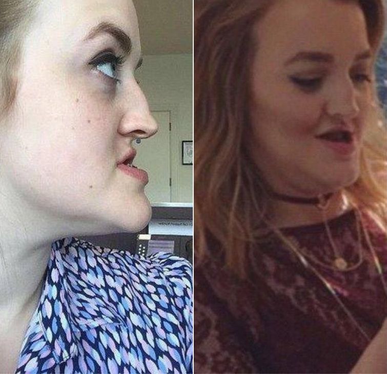 Пластическая операция на лицо до и после фото женщины