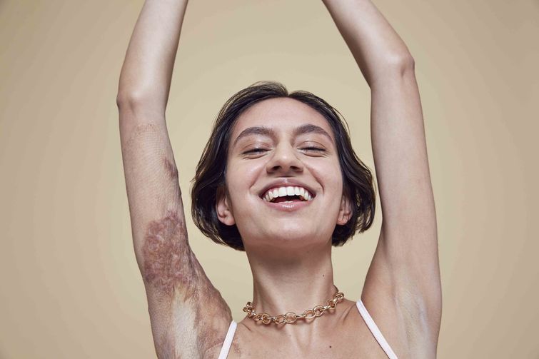 модели с проблемной кожей, модели с проблемами кожи, необычные модели, уникальные модели