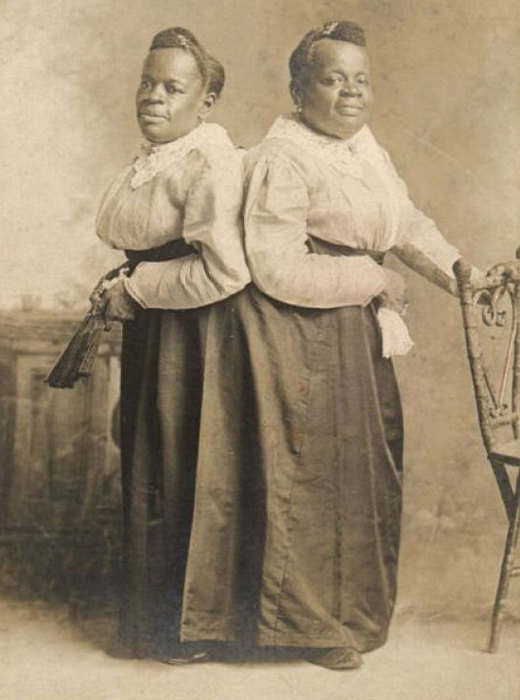 истории о сиамских близнецах, сиамские близнецы у которых все в жизни сложилось хорошо