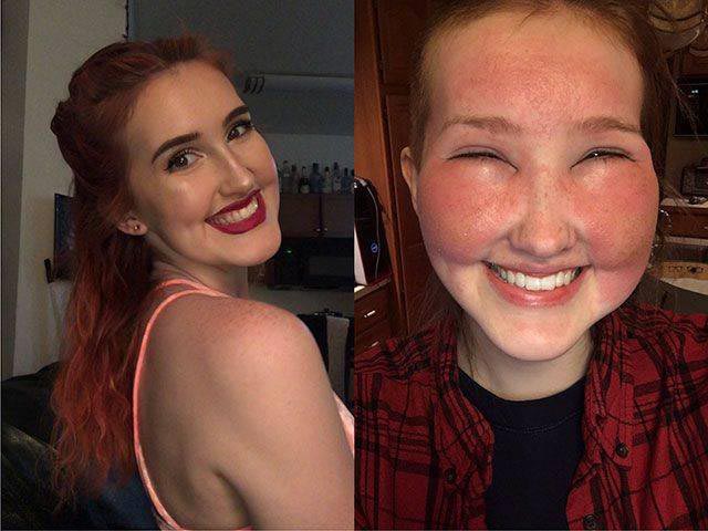 лица людей после аллергии, лица животных после аллергии, люди после аллергической реакции, животные после аллергической реакции