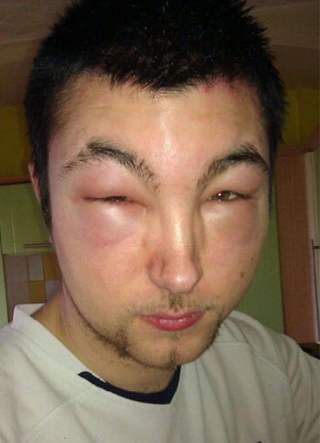 лица людей после аллергии, лица животных после аллергии, люди после аллергической реакции, животные после аллергической реакции