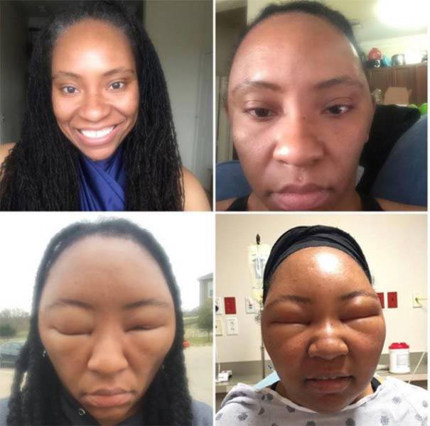 лица людей после аллергии, лица животных после аллергии, люди после аллергической реакции, животные после аллергической реакции