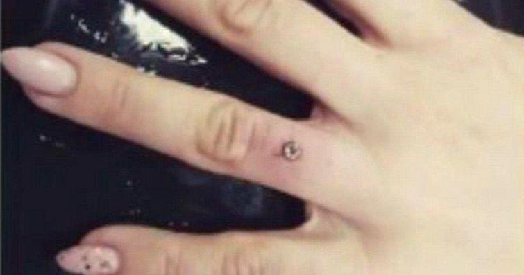 микродермалы вместо обручальных колец, что такое микродермал, микродермал в пальце, установка микродермала в палец