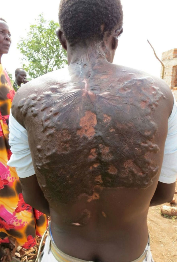 17 человек, которые выжили после удара молнии, показали следы, оставленные на их коже шрамы оставленные ударом молнии, люди выжили после удара молнии и показали следы оставленные на их коже