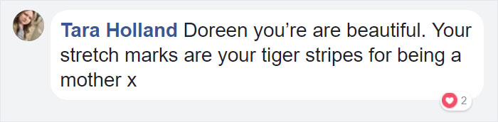 растяжки после беременности, глубокие растяжки после беременности, ужасные растяжки, растяжки на животе