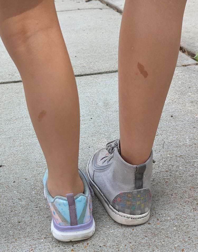 одинаковые родимые пятна на на ногах братьев