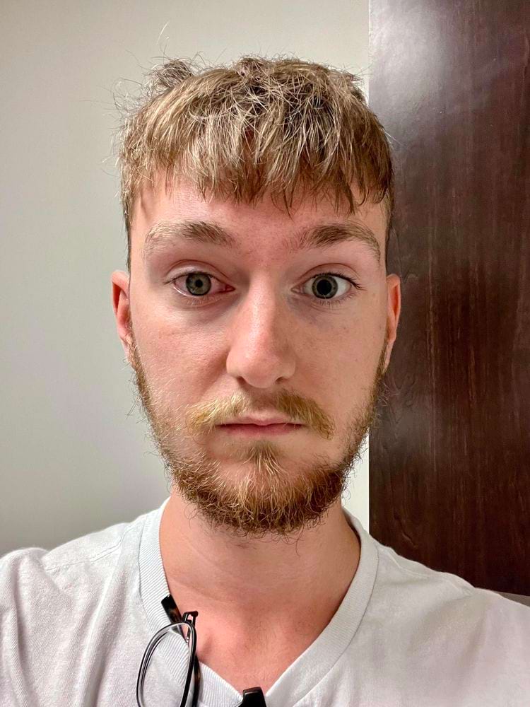 глаза до операции под названием лазерная фотокоагуляция