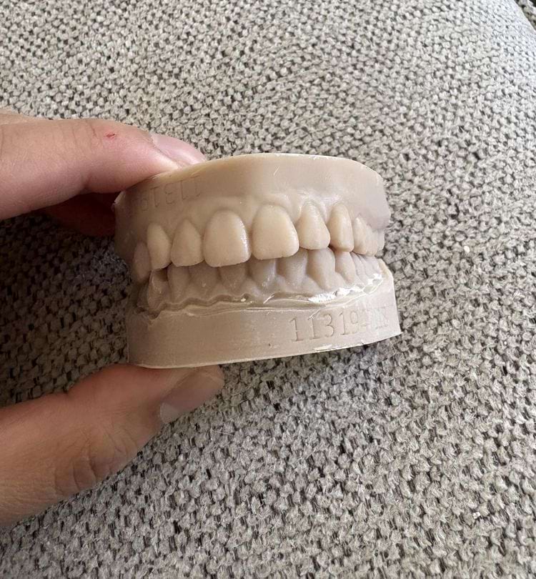 стоматолог сделал слепок моих зубов