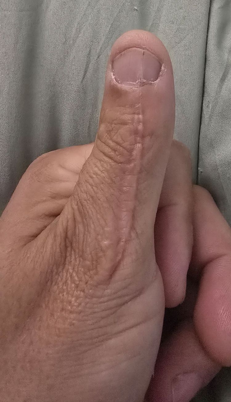 шрам на большом пальце руки