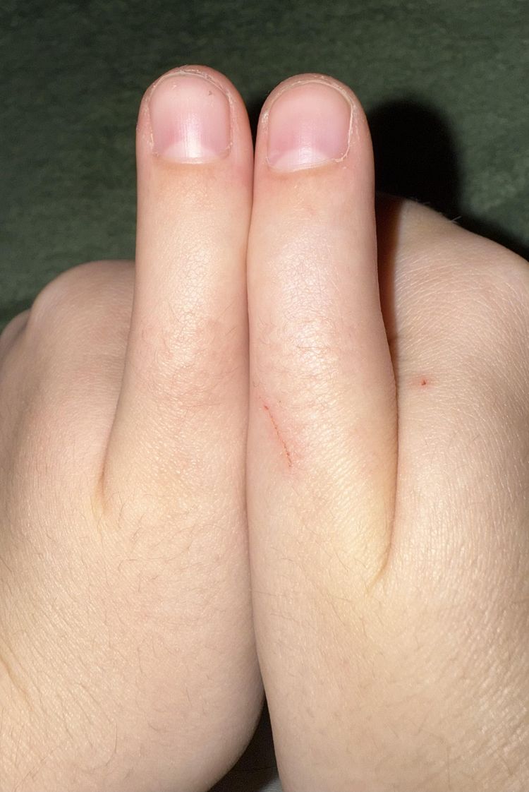 большие пальцы рук без морщинок