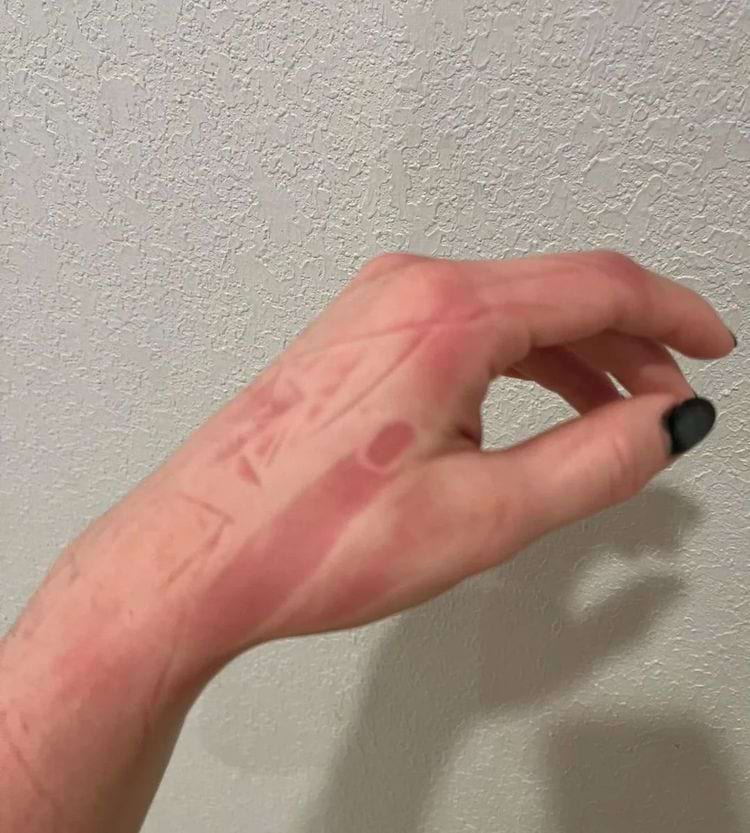 отпечаток пальца на руке после сна