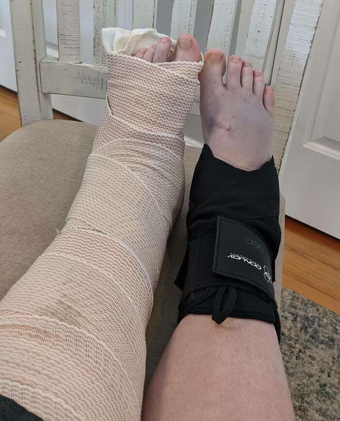 ноги с поломанными лодыжками