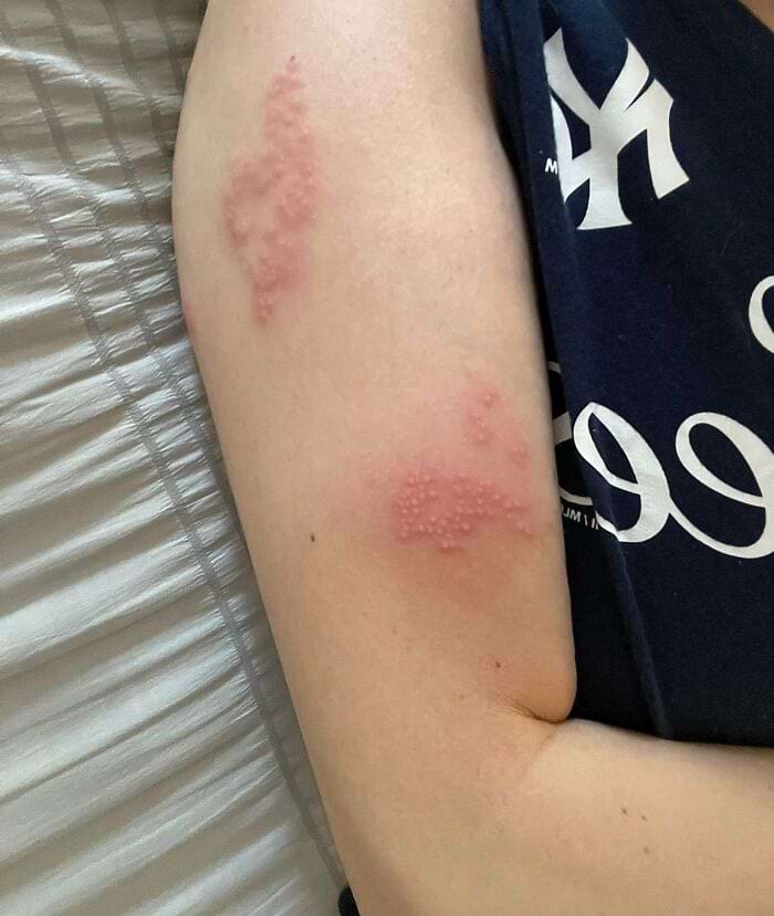 опоясывающий лишай