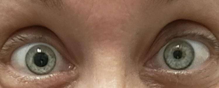 глаза, у которых один зрачок гораздо больше другого