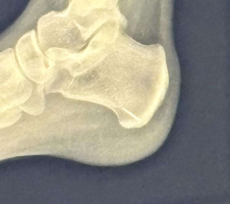 игла застряла в кости пятки