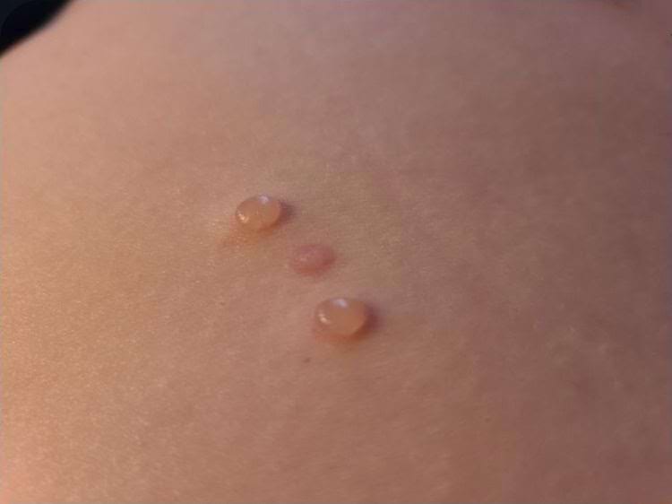 волдыри на коже