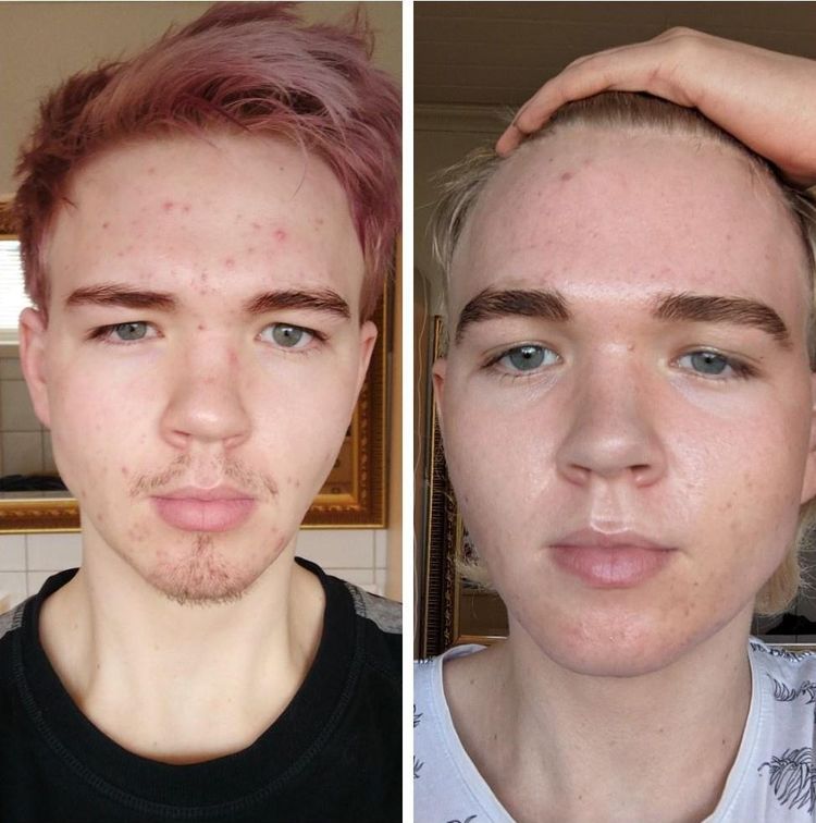 18 людей, которые победили свою проблемную кожу и теперь делятся ...