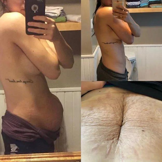 До и после похудения живот после родов фото