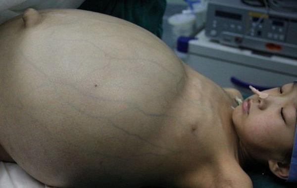 Удалили гигантскую опухоль у китайской девочки, тератома яичников, Хан Бингбинг Han Bingbing